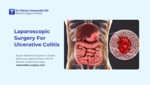 Ulcerative Colitis