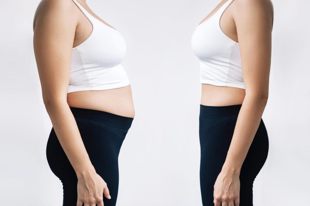 Gastric Sleeve Surgery Before and After