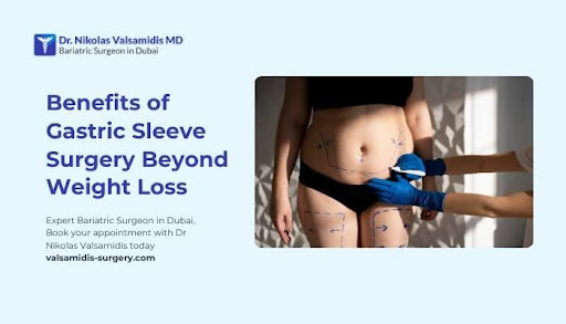 Benefits of Gastric Sleeve Surgery