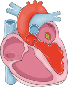 nikolas 11The Heart Attack Mimic When Chest Pain is Actually a Hiatal Hernia