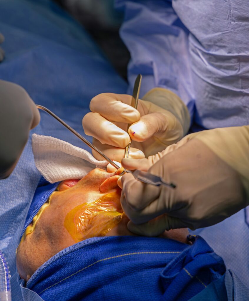 Incisional Hernia
