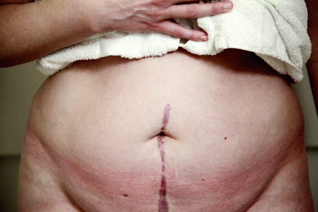 appendix surgery
