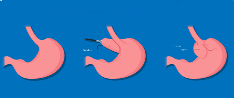 nissen fundoplication surgey 